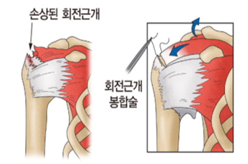 회전근개봉합술 이미지(서울아산병원 홈페이지)