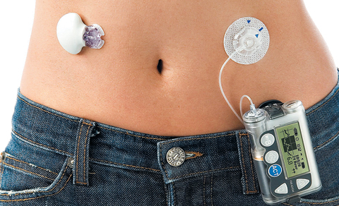 2000년대 초기 연속혈당측정기 제품 (당시 국내엔 도입되지 않았다.) 