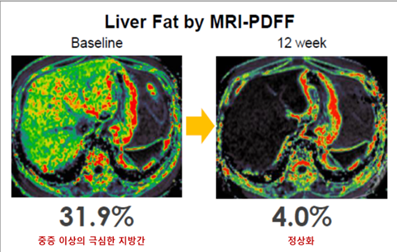 MRI-PDFF 검사로 확인한 지방간 감소 효과<br>