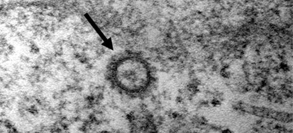 코로나19 바이러스(SARS-CoV-2)의 전자현미경 사진