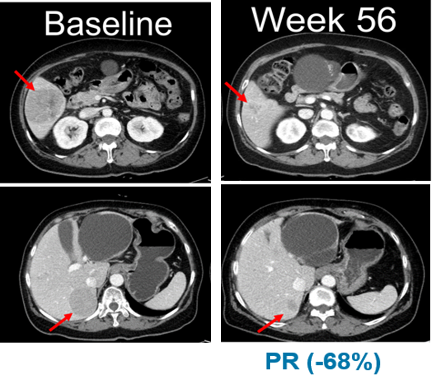 임상 시작 전(Baseline,좌측)과 벨바라페닙 투여 56주 후 흑색종 환자의 복부 CT사진. (사진제공=한미약품)