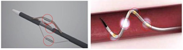 칼로스메디칼에서 개발중인 카테터(왼쪽)와 메드트로닉이 개발중인 카테터, 붉은색 원이 전류자극 부분이다.