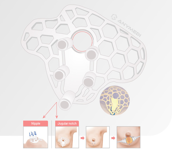 애니메디솔루션의 유방보존술 가이드