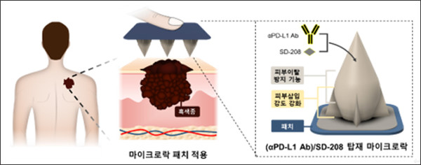피부 흑색종 항암 치료 MicroLock(마이크로락) 패치.