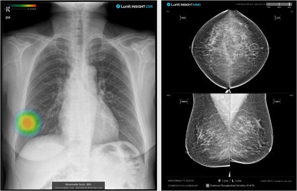 루닛의 AI 암 진단보조 제품군 Lunit INSIGHT CXR(왼쪽), Lunit INSIGHT MMG