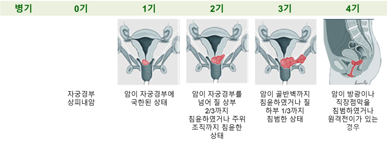 자궁경부암의 진행단계(병기) / 사진=한국MSD