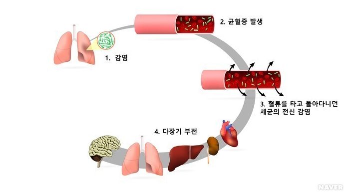 패혈증 감염 과정 모식도 / 출처 = 네이버 건강백과 
