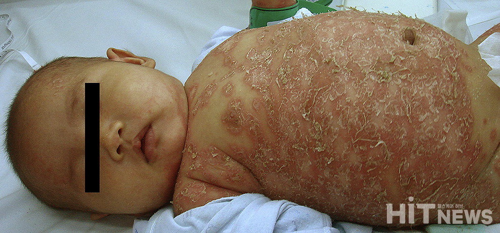 3세 전신농포성슬롯사이트 볼트 여아 환자 / 출처=Infantile generalized pustular psoriasis, a case report and review of the literature, Dermatologica Sinica Volume 29, Issue 1, 2011 3월 발행