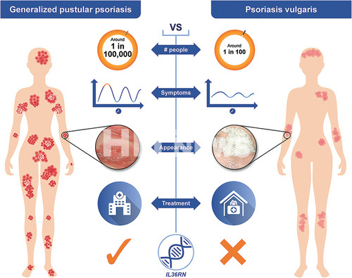전신농포슬롯사이트 볼트 및 판상슬롯사이트 볼트 비교 인포그래픽 / 출처='Generalized pustular psoriasis is a disease distinct from psoriasis vulgaris evidence and expert opinion', Expert Rev Clin Immunol, 2022년 10월 18일 발행