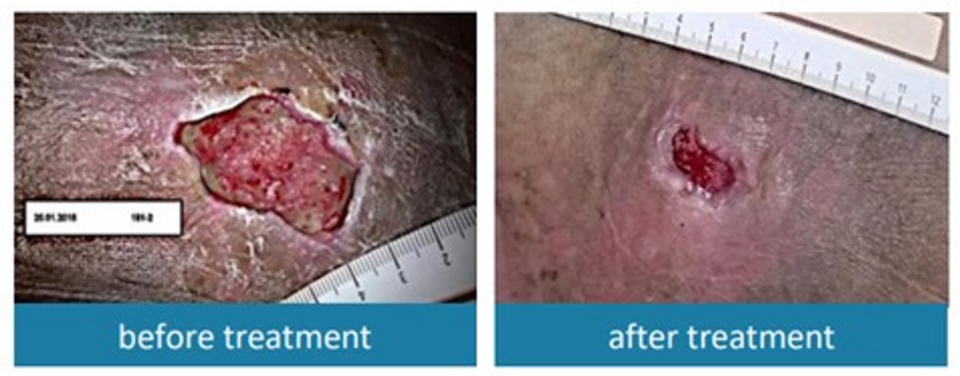 환자의 상처를 엔돌라이신함유 MD 제품으로 7회 치료한 전후 비교 사진(환부 면적 약 82% 감소) / 출처=라이산도 임상 자료
