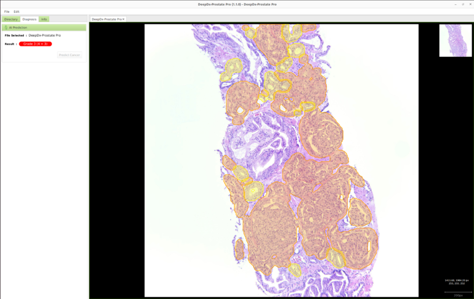 'DeepDx-Prostate Pro'의 AI 기반 전립선 생검 디지털 이미지 분석 결과 예시 / 사진=딥바이오