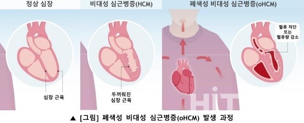 <BR>폐색성 비대성 심근병증 발생 과정 / 사진=한국BMS제약