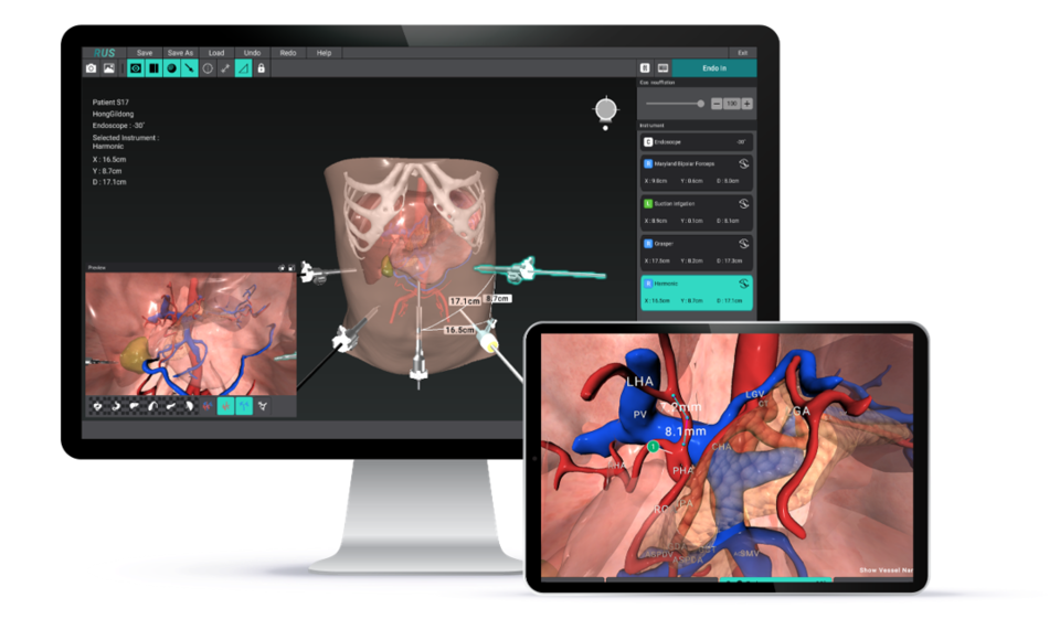 휴톰의 수술 네비게이션이 구동하는 모습 / 그래픽=휴톰