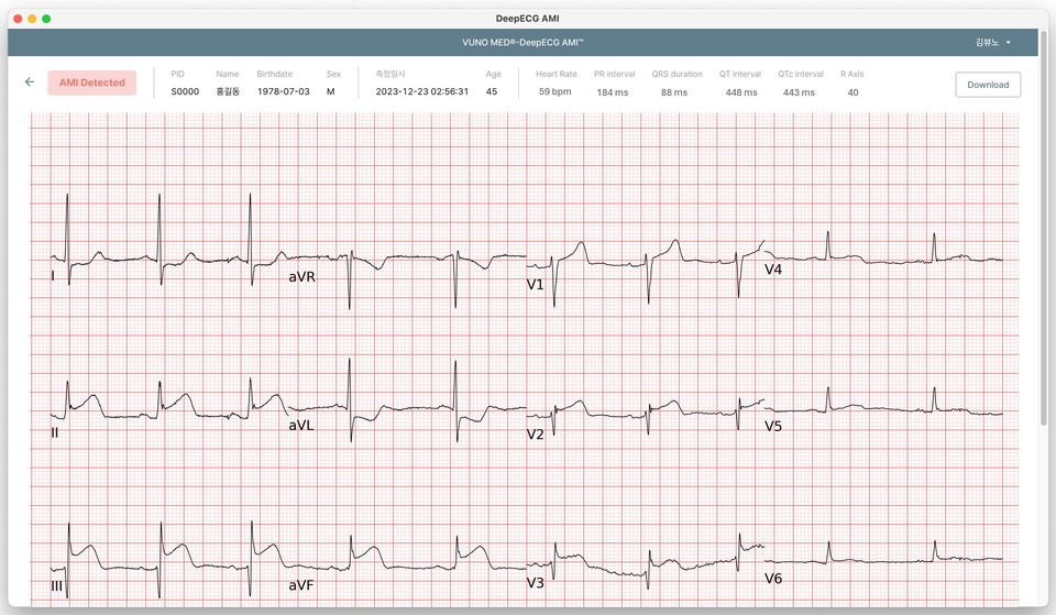 VUNO Med®-DeepECG™ AMI 운영화면 예시 / 사진=파라오 슬롯