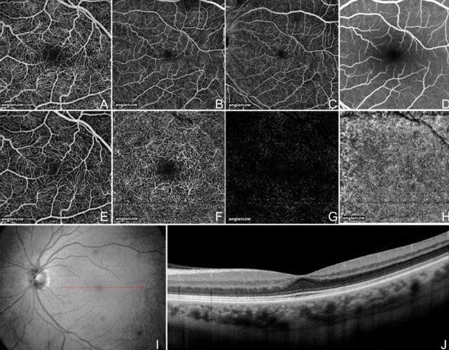 안구 광간섭 단측 촬영(OCT) 예시 / 출처= 'A review of optical coherence tomography angiography(OCTA)', Talisa E de Carlo 등 저자