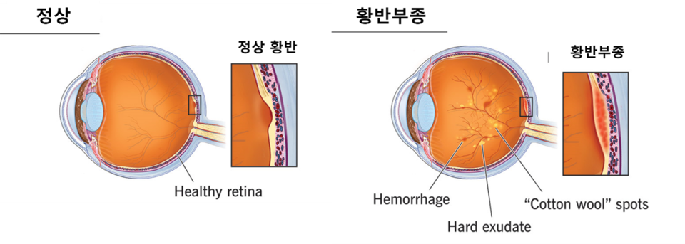 정상인의 안구(사진 왼쪽)과 황반부종이 발생한 안구 / 그래픽=클리브랜드 클리닉(Cleveland Clinic) 이미지 재구성