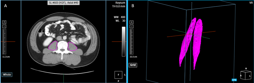 CT데이터에서 인공지능으로 추정된 요근 형태 / 사진=코어라인소프트
