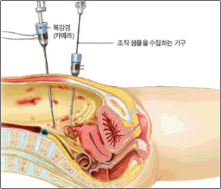 복강경을 통한 바카라 전략 진단 / 사진=대한바카라 전략학회