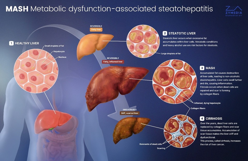 대사이상 관련 지방간염(MASH) 발병 기전을 설명한 자이미디어의 2D 디자인물. / 그래픽=자이미디어