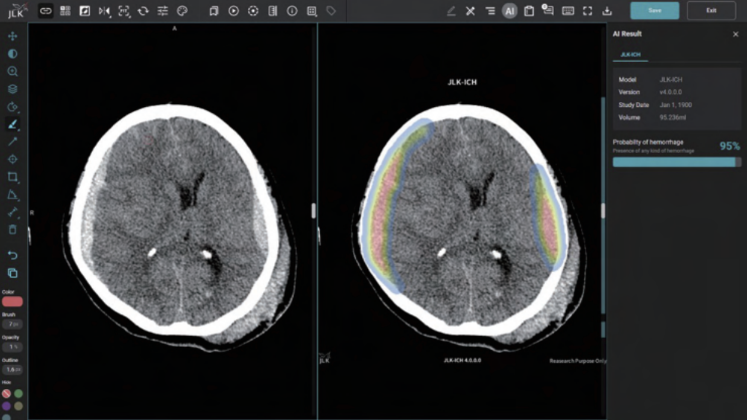 바카라 사이트 뇌출혈 검출 솔루션 JLK-ICH / 사진제공 = 바카라 사이트