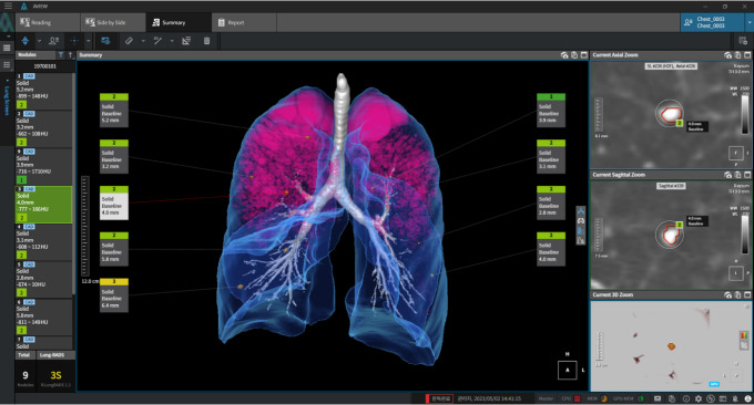 흉부CT에서 폐 관련 big3 질환을 동시 검출 분석하는 AVIEW LCS Plus / 사진 제공 = 코어라인소프트