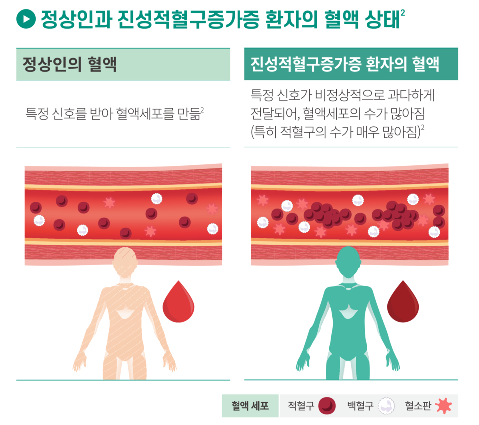 출처=자카비 진성적혈구증가증 환자 안내서 