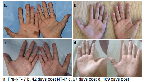 NT-I7 투여로 인한 피부 병변 개선 결과 / 출처=네오이뮨텍, ESID-EHA-SIOPE Focused Symposium 발표 포스터