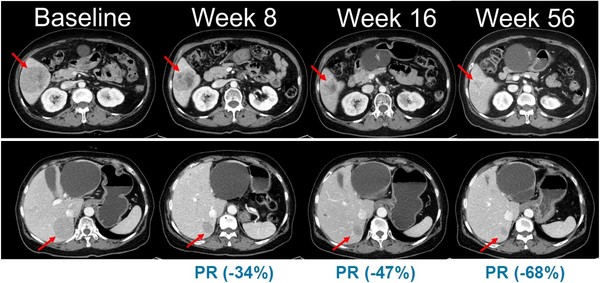 NRAS 돌연변이 흑색종 환자를 대상으로 진행된 벨바라페닙과 코비메티닙 병용요법 임상시험에서 시간 경과에 따른 병변 변화가 관찰된 복부 CT 영상. 출처=미국임상종양학회(ASCO) 2021 구연 발표.